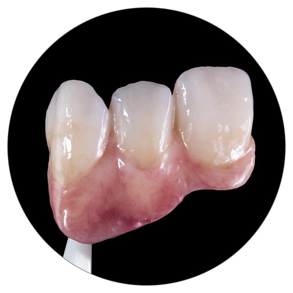 Zona gingival