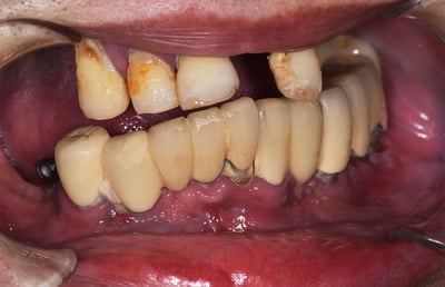 1. La dentadura remanente no conservable del paciente antes de la extracción.