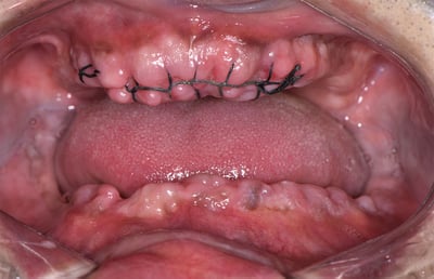 2. Postoperative status with compact sutures in the upper jaw.