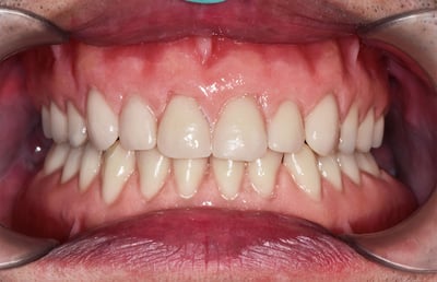 5. Both dentures are integrated absolutely harmoniously in the mouth.