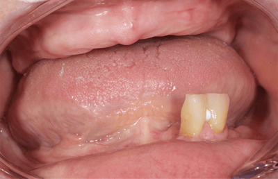 1. Les dents restantes, 32 et 33, ne présentaient aucun signe d'inflammation.