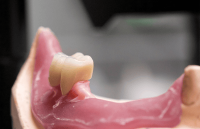 3. Los dientes posteriores lingualizados VITA MFT durante el montaje.