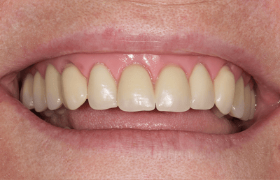 6. Los dientes posteriores lingualizados VITA MFT proporcionan más espacio para la lengua.