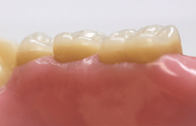 4. Céntrica sencilla con contactos vestibulares en la región molar.
