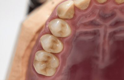 View on the final upper wax set up in the molar region.