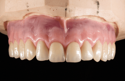 The finally contoured wax set up in the upper jaw.