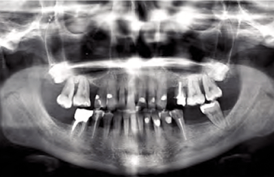 1. Le radiografie evidenziano diversi denti con severo riassorbimento osseo, che hanno dovuto essere estratti.