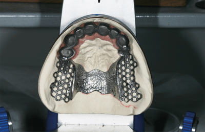 10. The fabricated secondary crowns with tertiary structure. 