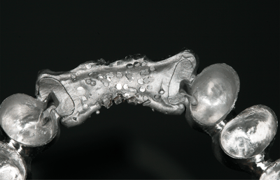 11. la estructura para el maxilar inferior se confeccionó en tres piezas y posteriormente se soldó mediante láser.