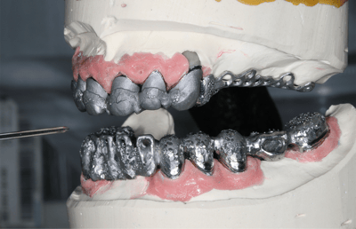 13. Primary crowns and frameworks in the articulator. 
