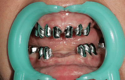 17. The integrated primary crowns after removal of cement residues. 