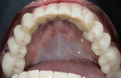 19. vue occlusale de la prothèse télescopique intégrée dans la mandibule. 