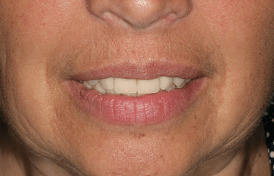 20. les lèvres et les joues de la patiente sont stabilisées grâce à ses nouvelles réhabilitations. 