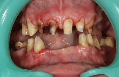 3. The remaining abutment teeth were prepared for the primary crowns. 