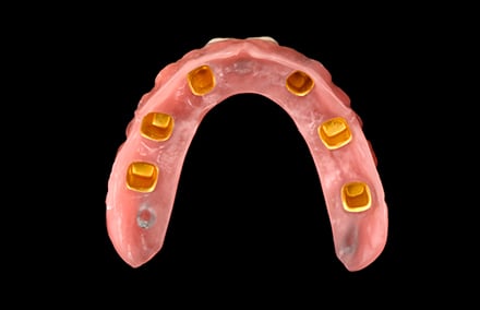 13. Ansicht von basal. Die Sekundärteile wurden vor der Fertigstellung intraoral mit dem Gerüst verklebt.