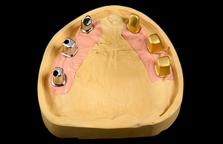 1. Oberkiefer-Implantatmodell mit Titan-Abutments (=Primärteile) und Galvanokappen (=Sekundärteile)