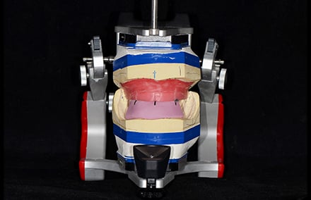 13. réalisation d'une clé en silicone pour orienter le montage dans la zone esthétique.