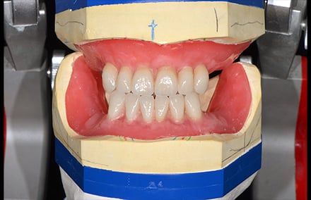 18. secteurs antérieurs montés à l'aspect parfaitement naturel grâce aux dents VITA PHYSIODENS individualisées.
