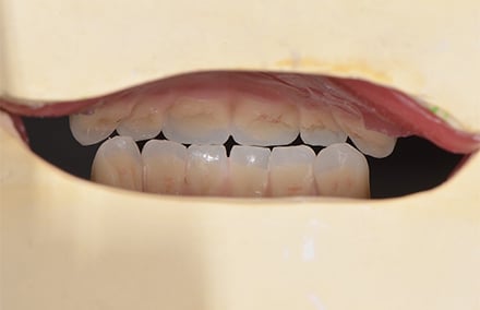 20. montage en cire des dents antérieures, en vue linguale.