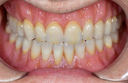 24. : réhabilitation par prothèse complète adaptée à l'âge lors de la mise en bouche.