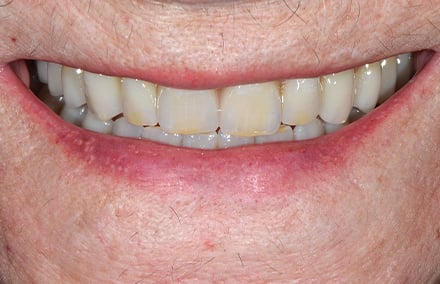 25. tracé des bords incisifs harmonieux avec le contour de la lèvre inférieure.