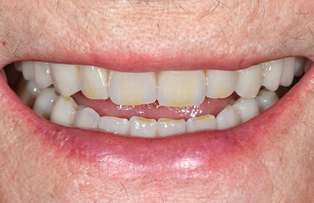 26. le nouveau sourire obtenu avec VITA PHYSIODENS semblait absolument naturel.