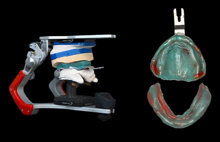 2. Impresiones mucodinámicas y transferencia del arco facial al articulador.