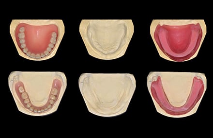 3. anciennes prothèses fortement abrasées et enregistrements d'occlusion réalisés sur les maîtres-modèles.