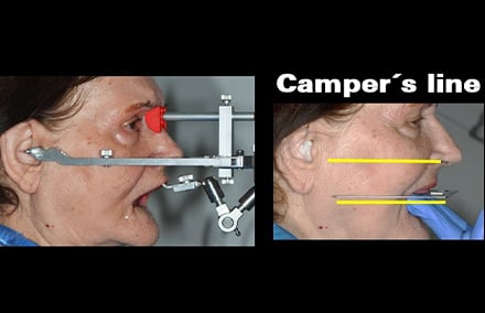 5. vérification du plan de mastication avec l'occlusiographe et enregistrement avec l'arc facial.
