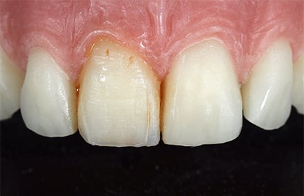 10. Ein feiner Haarriss sowie zervikale und approximale Verfärbungen wurden angelegt.
