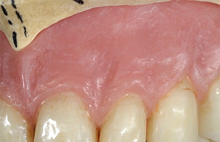 14. Nachdem alle Frontzähne modifiziert worden waren, wurde das vestibuläre Lippenschild individualisiert.