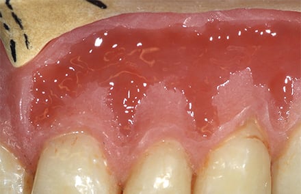15. Die Alveolarmukosa wurde bis zur mukogingivalen Grenze mit braunrotem GINGIVA 4 kreiert.