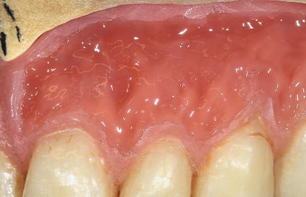 16. Im Bereich der befestigten Gingiva wurde helleres GINGIVA 1 (altrosa) aufgetragen.