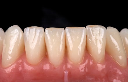 30. Eine dezente Asymmetrie der Gingiva erzeugt einen natürlichen Eindruck.