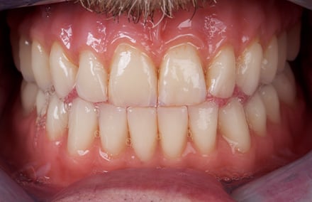 33. Die eingearbeiteten Schlifffacetten an den Inzisiven harmonierten funktionell in der Protrusion.