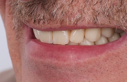 34. Die Inzisalkanten der Oberkieferinzisiven passten zum Lippenverlauf.