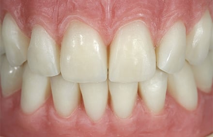 5. Auf die Umsetzung, folgte das Abstrahlen der Zähne und des vestibulären Lippenschilds mit Aluminiumoxid.