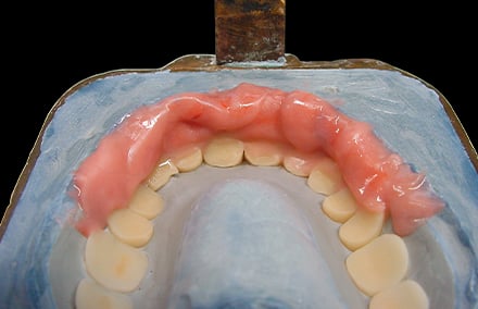 23.  Labial eingelegte Gingiva.