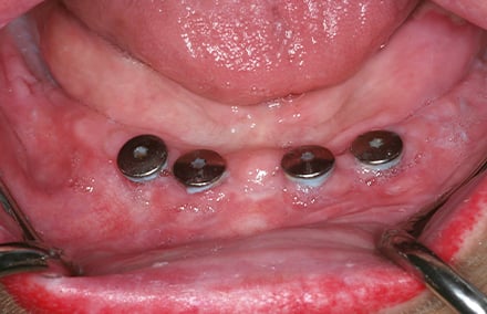 2.  Zahnloser UK mit 4 Implantaten.