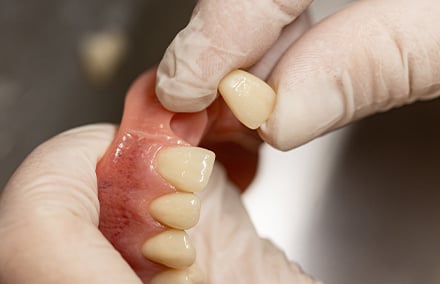 3. The prefabricated tooth for the digital prosthesis, VITA VIONIC VIGO, during the fit check.