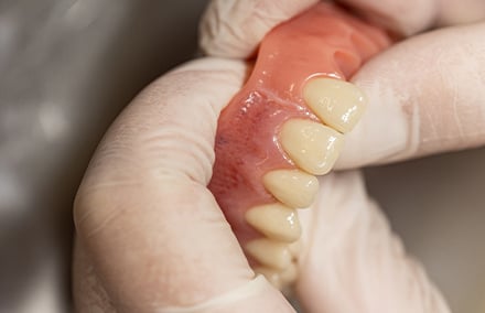 6. Tooth 21 after its precise insertion into the denture base.