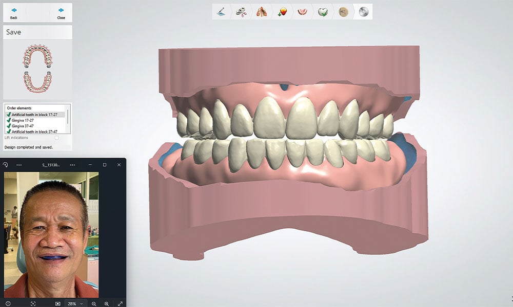 2. Die totalprothetische Rehabilitation wurde in der 3Shape CAD Software konstruiert.