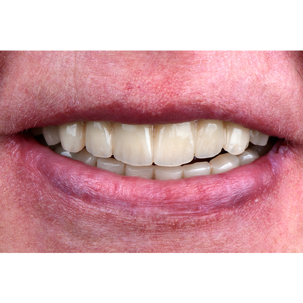 10. The VITA VIONIC DENT DISC multiColor offers the esthetics and functionality of VITA premium teeth.