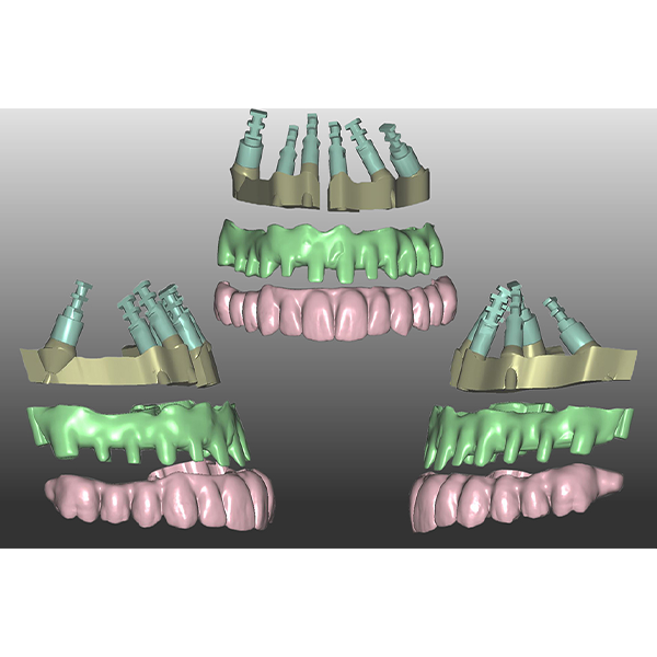 1. Construction with zirconia bridges, a secondary framework made of PEEK, teeth made of VITA VIONIC DENT DISC multiColor.