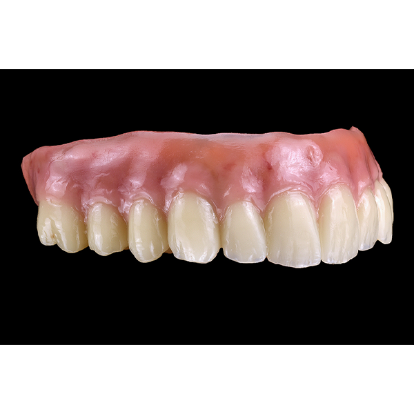 7. The finished implant-prosthetic restoration after mucogingival reproduction with the veneering composite VITA VM LC flow.
