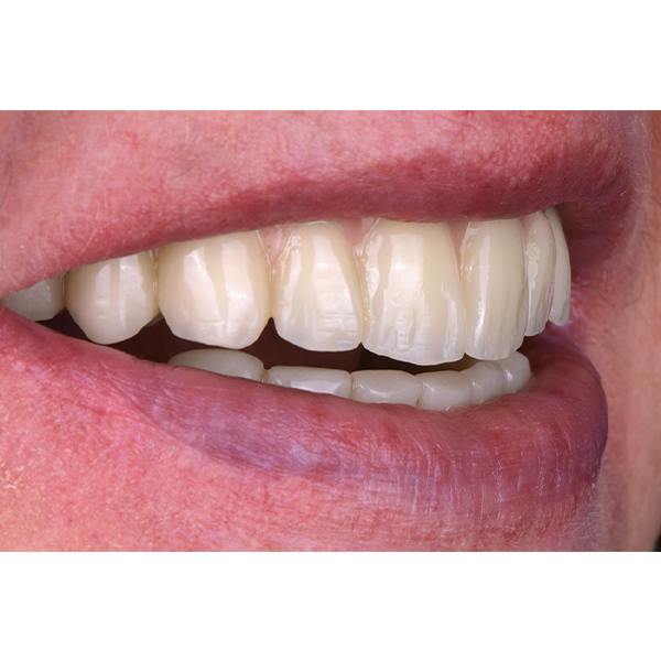9.Lateral view of the vibrant tooth material from the VITA VIONIC DENT DISC multiColor.