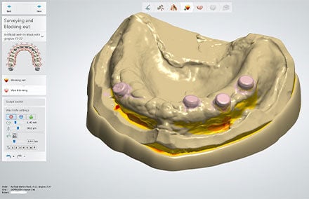 2. The virtual model during the analysis and block out phase.