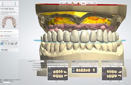 3. The virtual setup with the selection of tooth shapes.