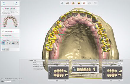 4. Checking the occlusal contacts and the freedom in centric.