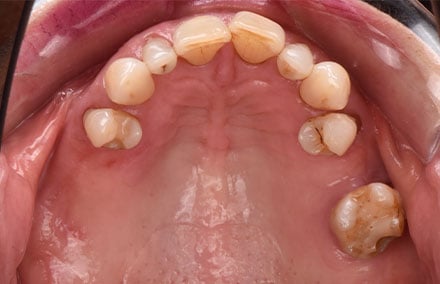 1. La dentadura parcialmente edéntula en el maxilar superior tras el tallado de apoyos para ganchos en los dientes 14, 24 y 26.